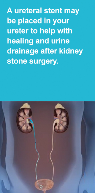 A ureteral stent may be placed in your ureter to help with healing and urine drainage after kidney stone surgery. A ureteral stent may be placed in your ureter to help with healing and urine drainage after kidney stone surgery.