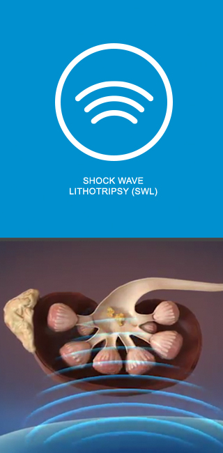 Shock Wave Lithotripsy (SWL) Shock Wave Lithotripsy (SWL)