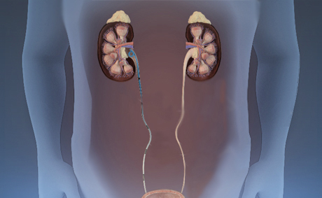 X-ray illustration of human torso showing stents and drainage