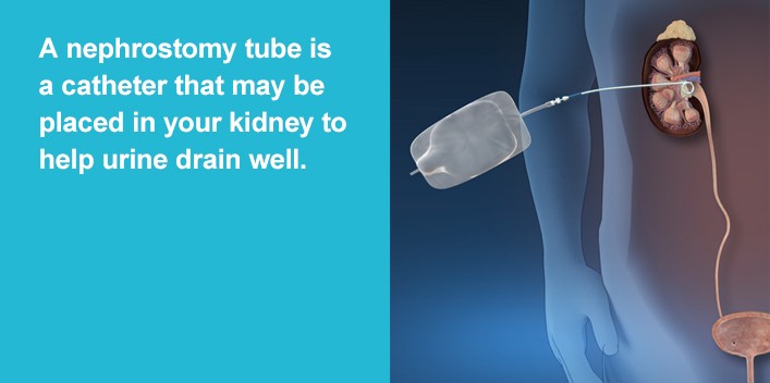 A nephrostomy tube is  a catheter that may be placed in your kidney to help urine drain well.