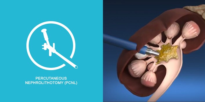 Percutaneous  Nephrolithotomy (PCNL)