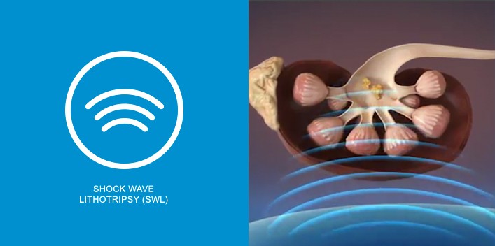 Shock Wave Lithotripsy (SWL)