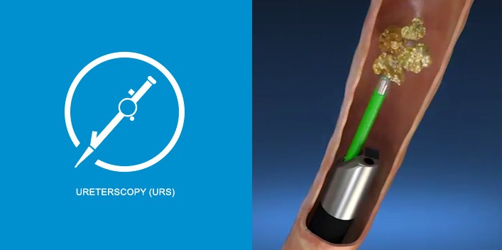 Ureteroscopic laser lithotripsy deals